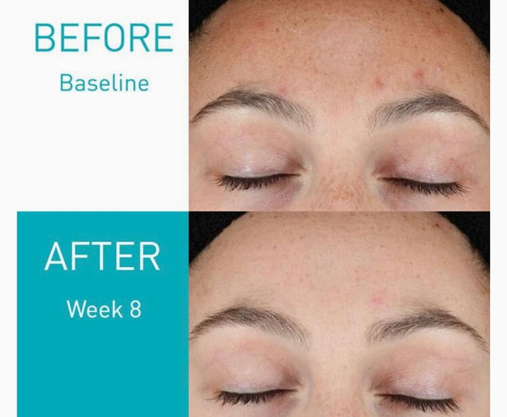 CeraVe Suero de retinol para marcas posteriores al acné y textura de la piel | Resurfacing Retinol Serum